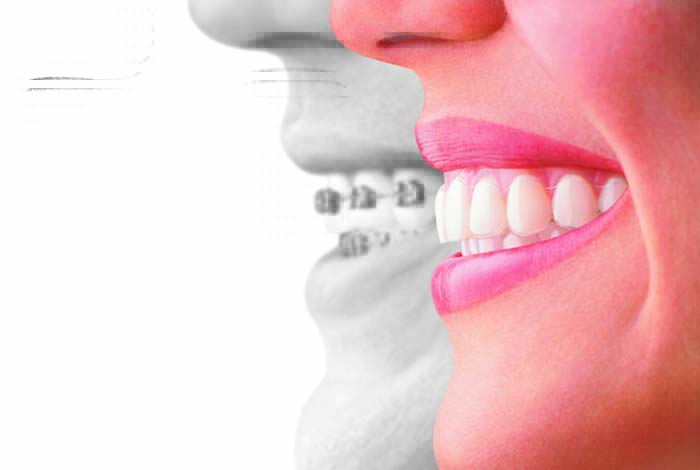 #InvisalignTalk on Straight Teeth - Invisalign compared to braces